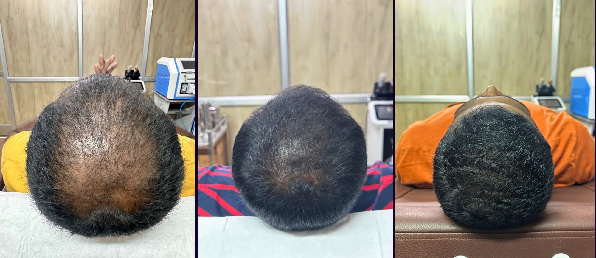 One person's crown photographed at three stages: visible thinning, partial regrowth, then full coverage.